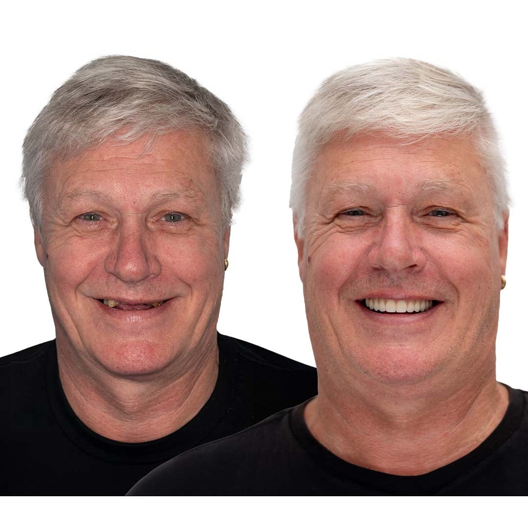 Affordable Removable Dentures with Flexible Cushion Grip Full Arch Set Cleaning