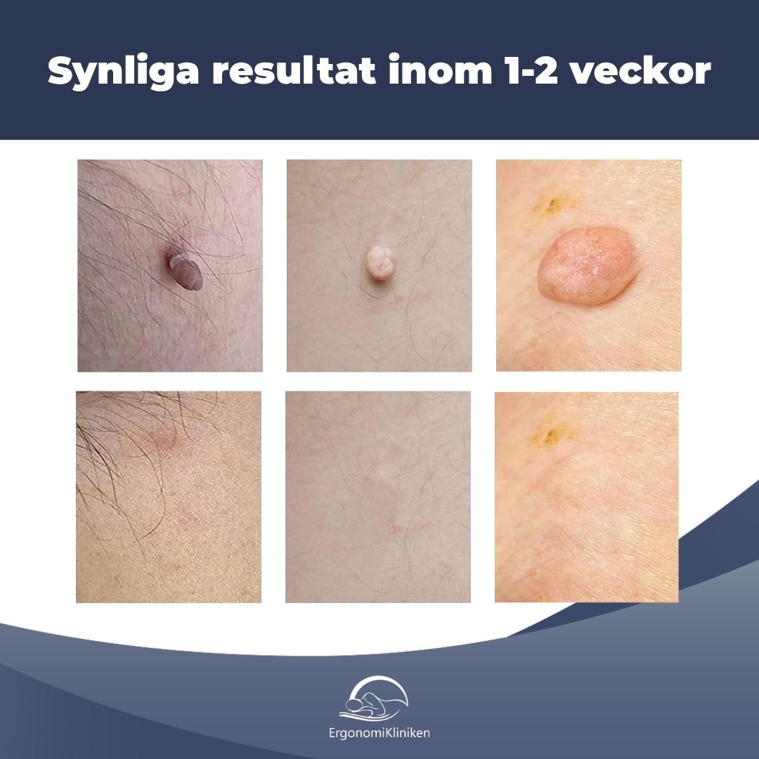 Skin Tag Removal Kit with Band Applicator for Armpit Eyelid and Under at Home