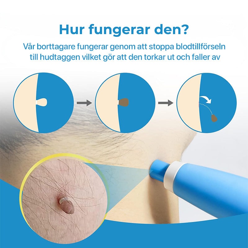 Skin Tag Removal Kit with Band Applicator for Armpit Eyelid and Under at Home