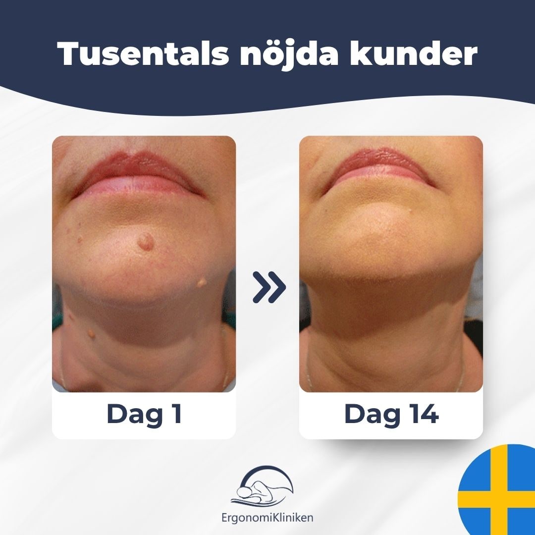 Skin Tag Removal Kit with Band Applicator for Armpit Eyelid and Under at Home