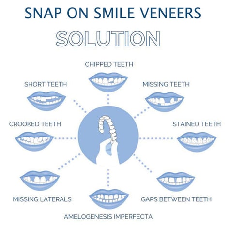 Snap on Cosmetic Dental Veneers Temporary Tooth Covers Upper Lower Set Instant Smile